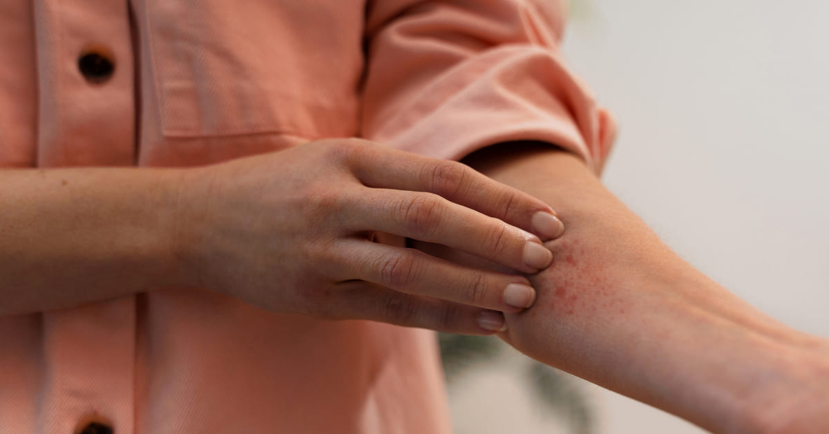 Penyebab Penyakit Lupus