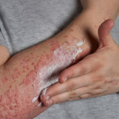 Penyakit Lupus: Penyebab, Gejala, dan Cara Mengobatinya