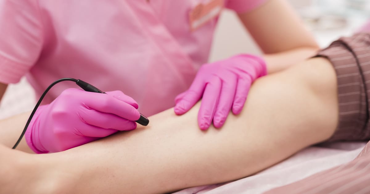 Cara Menghilangkan Varises di Kaki