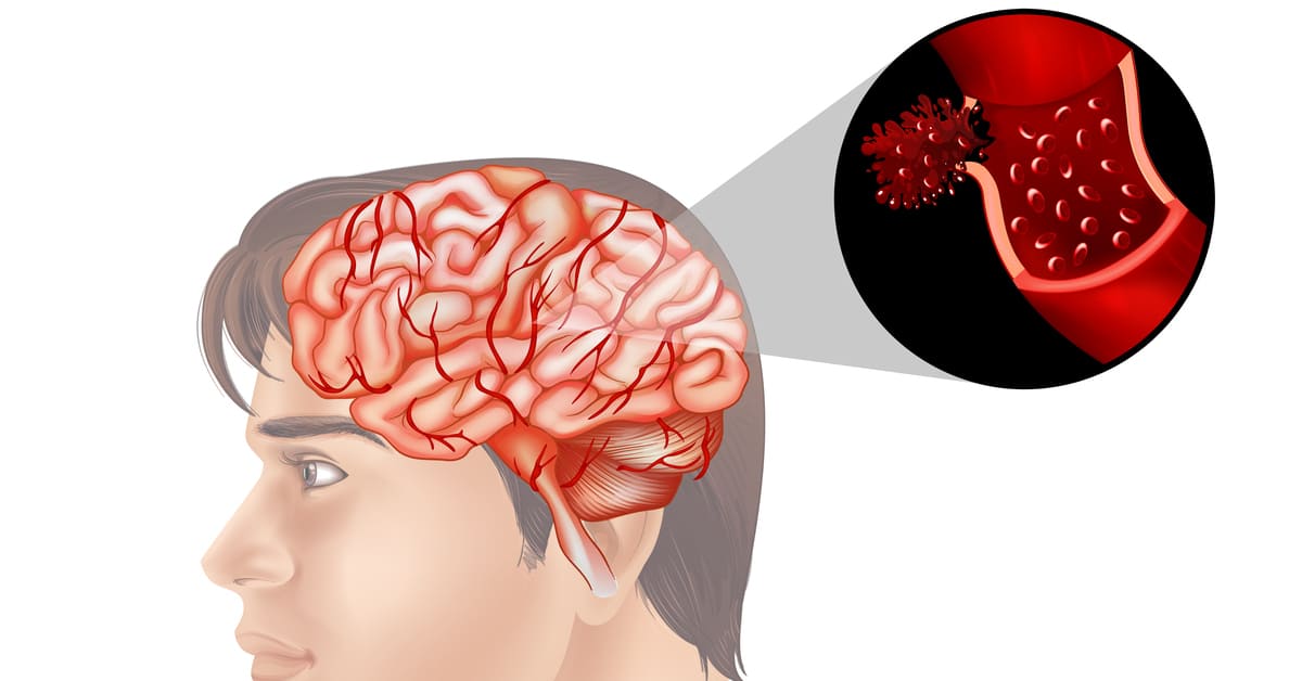 Penyebab Pecah Pembuluh Darah