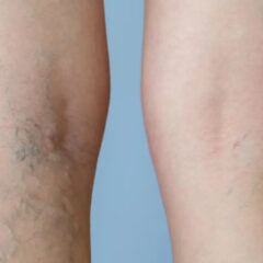 Apa Itu Varises? Ini Penyebab dan Cara menghilangkannya