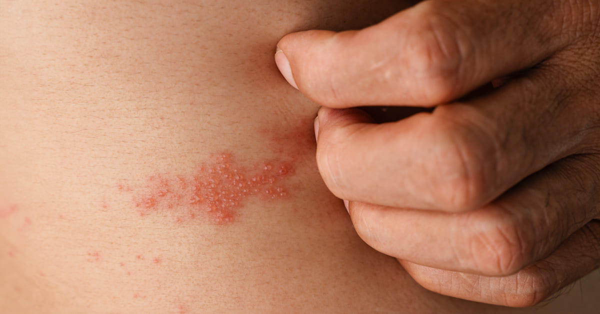 Pengobatan Penyakit Herpes