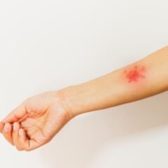 Apa itu Penyakit Herpes? Ini Gejala, Faktor Risiko dan Pengobatannya