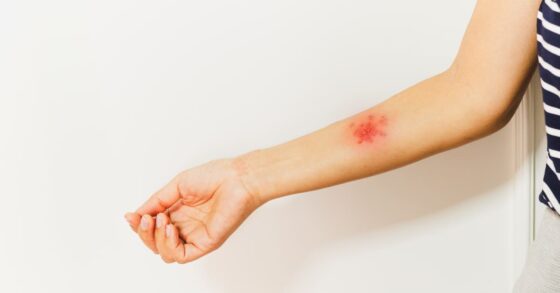 Apa itu Penyakit Herpes? Ini Gejala, Faktor Risiko dan Pengobatannya