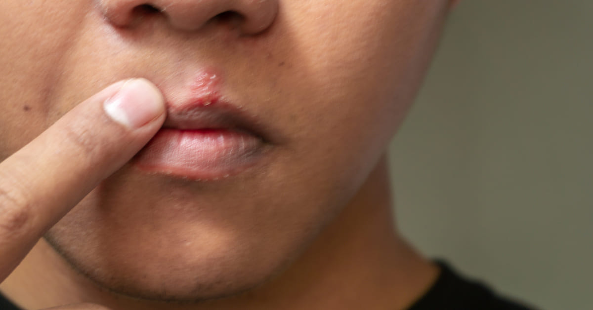 Gejala Penyakit Herpes