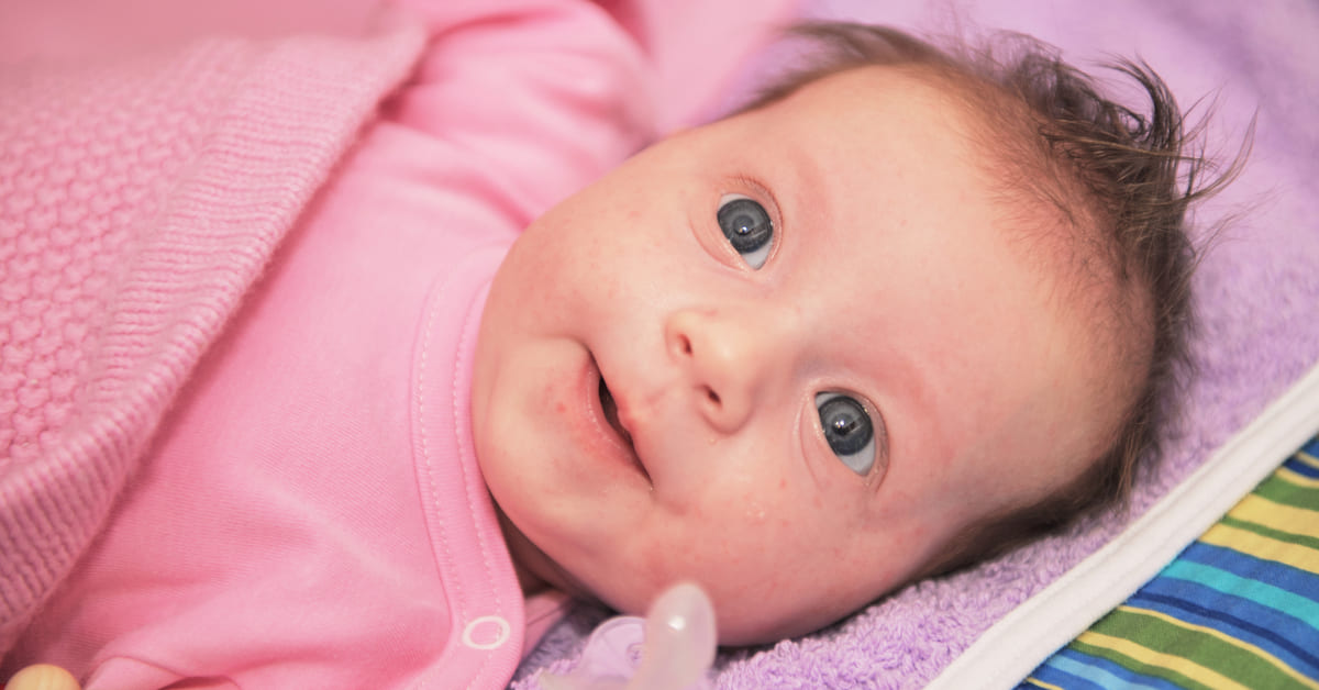 Gejala Penyakit Rubella