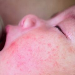 7 Gejala Penyakit Rubella, Penyebab dan Pencegahannya