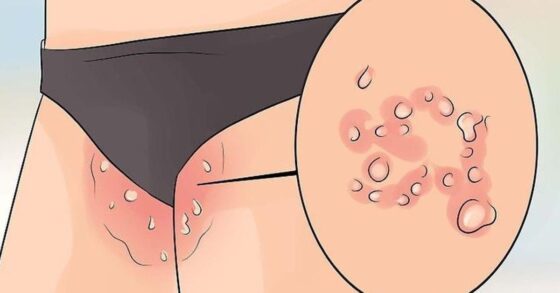 10 Penyebab Gatal di Selangkangan dan Cara Mengatasinya!