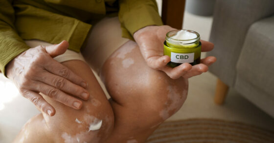 Salep Penghilang Bekas Luka: Cara Efektif Menghilangkan Bekas Luka dan Tips Memilih Produk yang Tepat