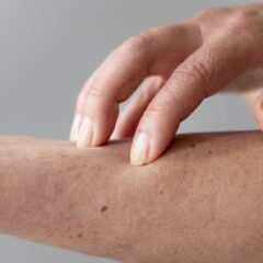 Biang Keringat: Penyebab, Gejala, dan Cara Mengatasi Secara Efektif