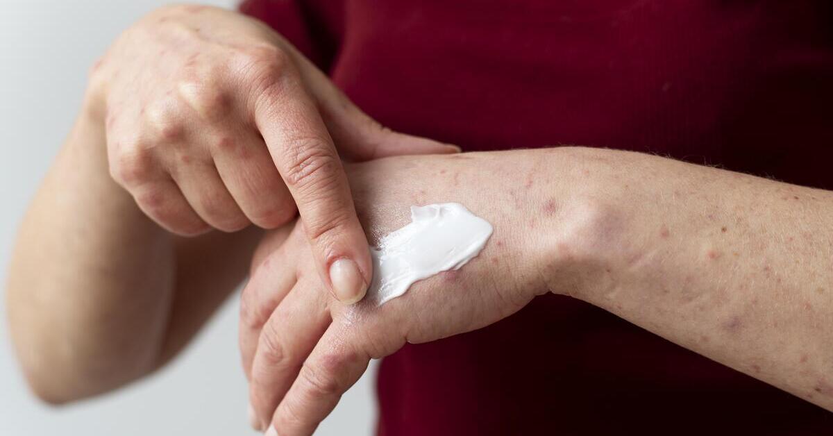 Langkah-Langkah Penggunaan Salep Penghilang Bekas Luka