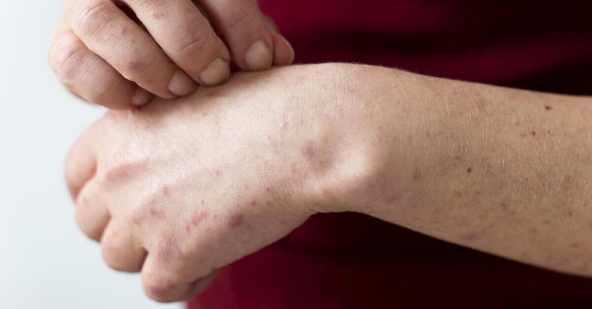 Pengobatan Biang Keringat di Apotek