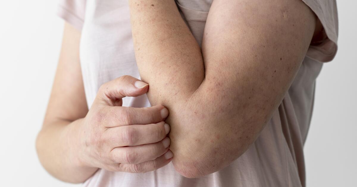 Gejala Biang Keringat