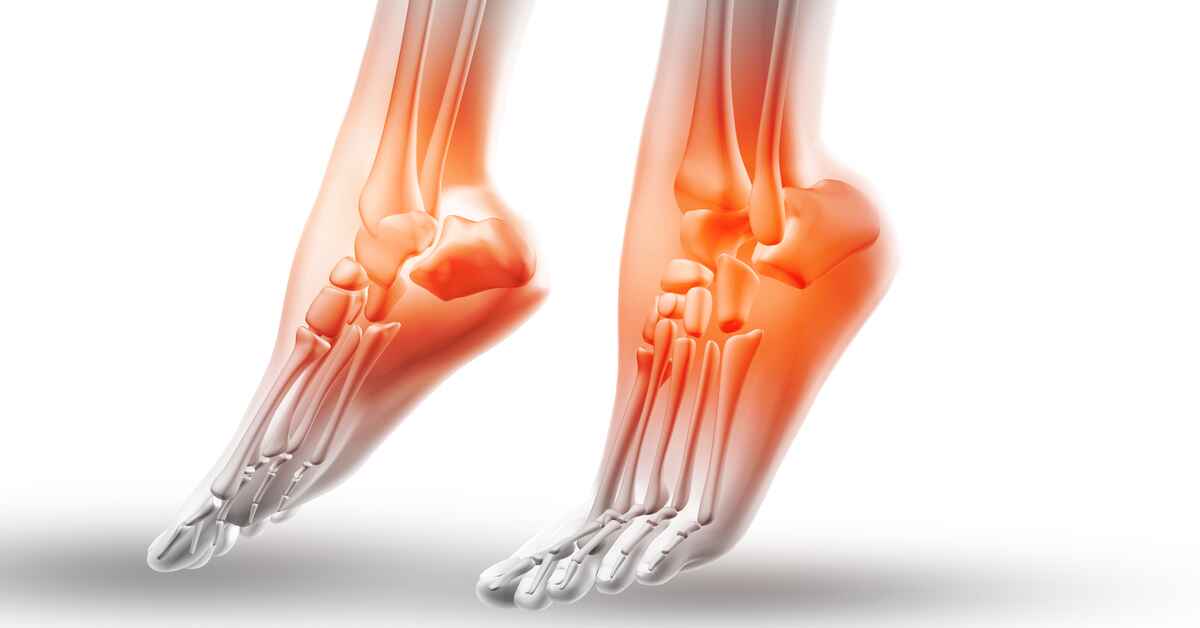 Cara Mengatasi Sakit Tumit Kaki