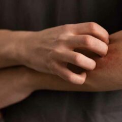 Penyakit Kurap: Penyebab, Gejala, Pengobatan, dan Cara Mencegahnya