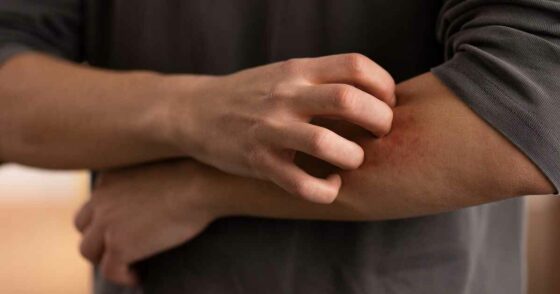 Penyakit Kurap: Penyebab, Gejala, Pengobatan, dan Cara Mencegahnya