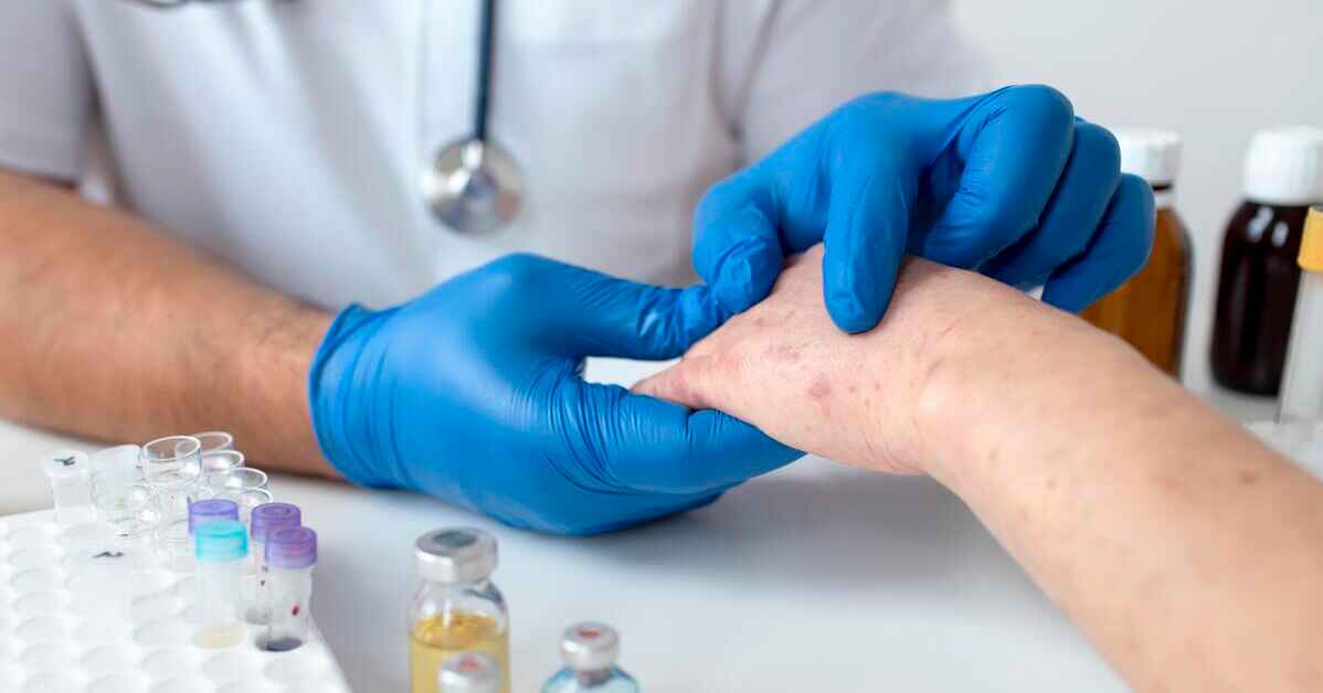 penyebab penyakit kurap