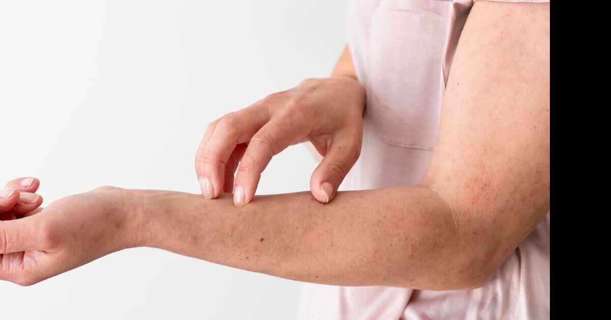 Gejala Penyakit Kurap