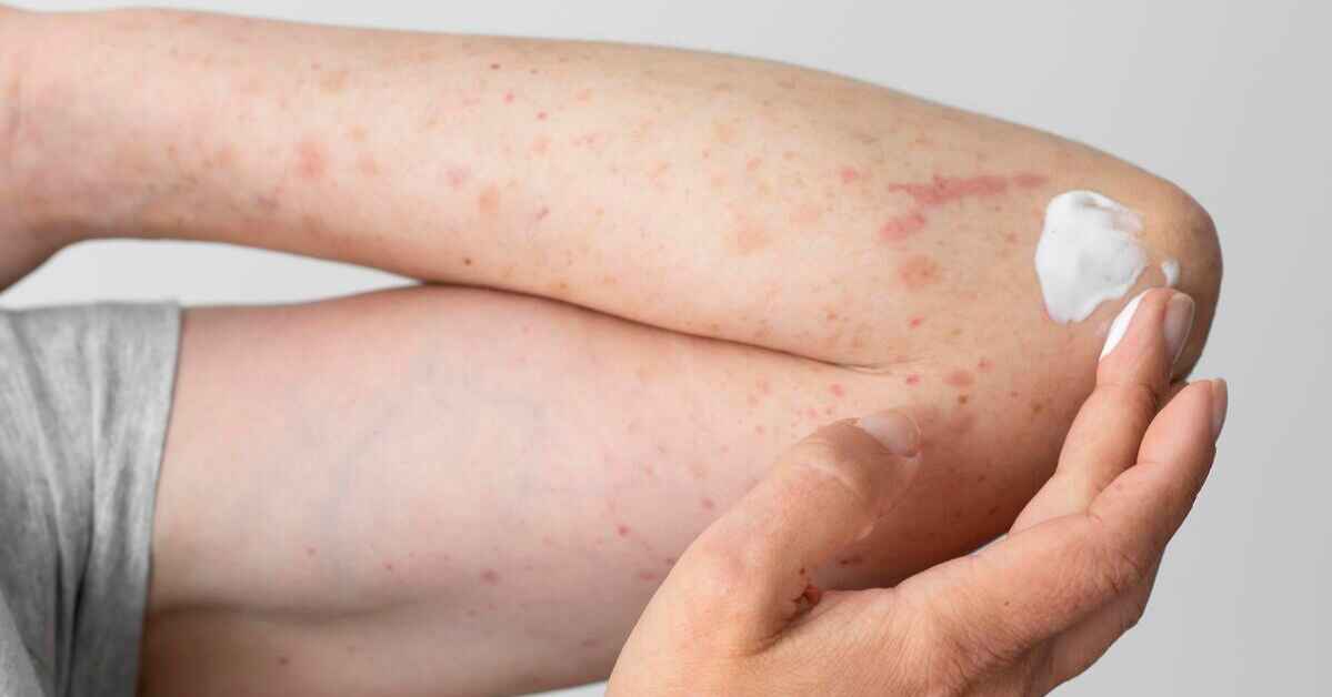 Pengobatan Penyakit Kurap