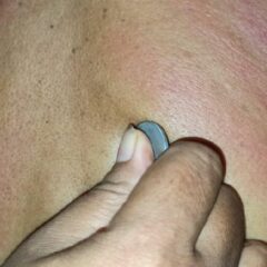 Apakah Kerokan Berbahaya? Ini Mitos, Fakta, dan Penjelasan Medis