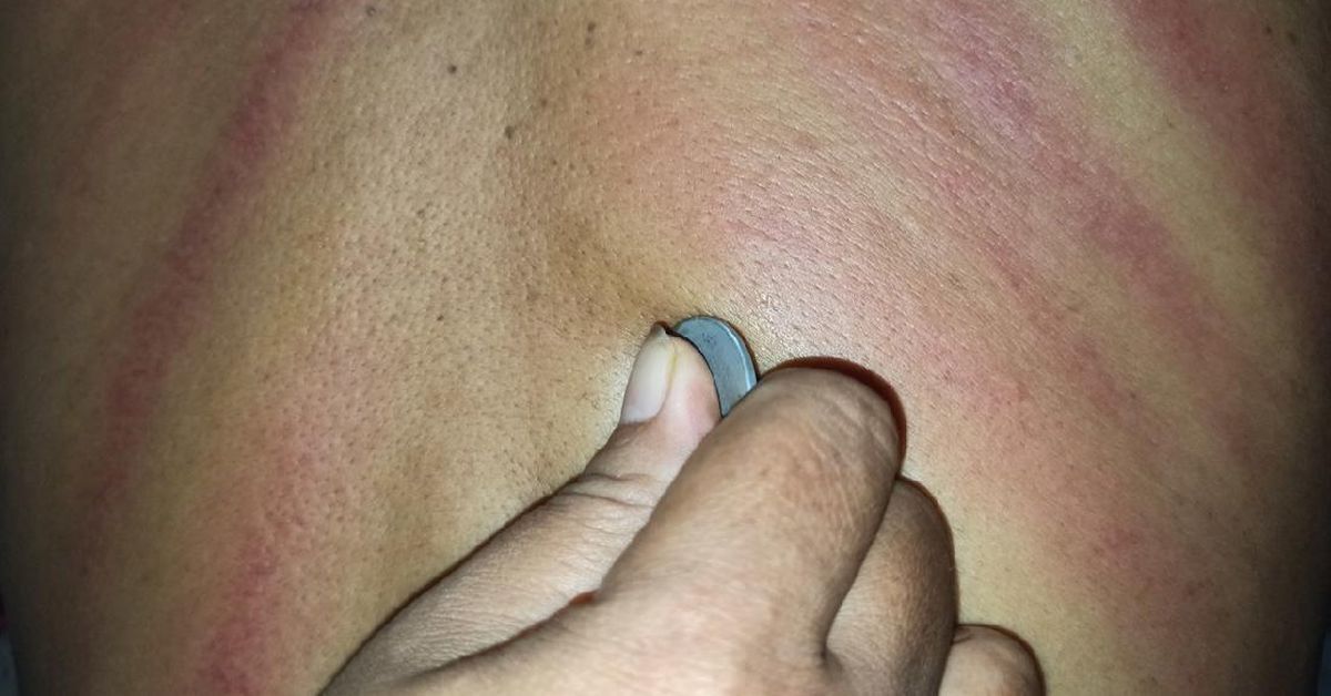 Apakah Kerokan Berbahaya? Ini Mitos, Fakta, dan Penjelasan Medis