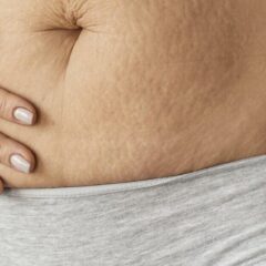 8 Penyebab Stretch Mark yang Bisa Kamu Ketahui