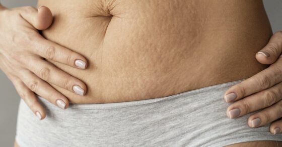 8 Penyebab Stretch Mark yang Bisa Kamu Ketahui
